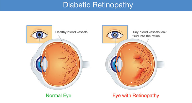 diabetic retinopathy adult pediatric eyecare local eye doctor near you